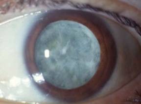 Cataratas a un 85%